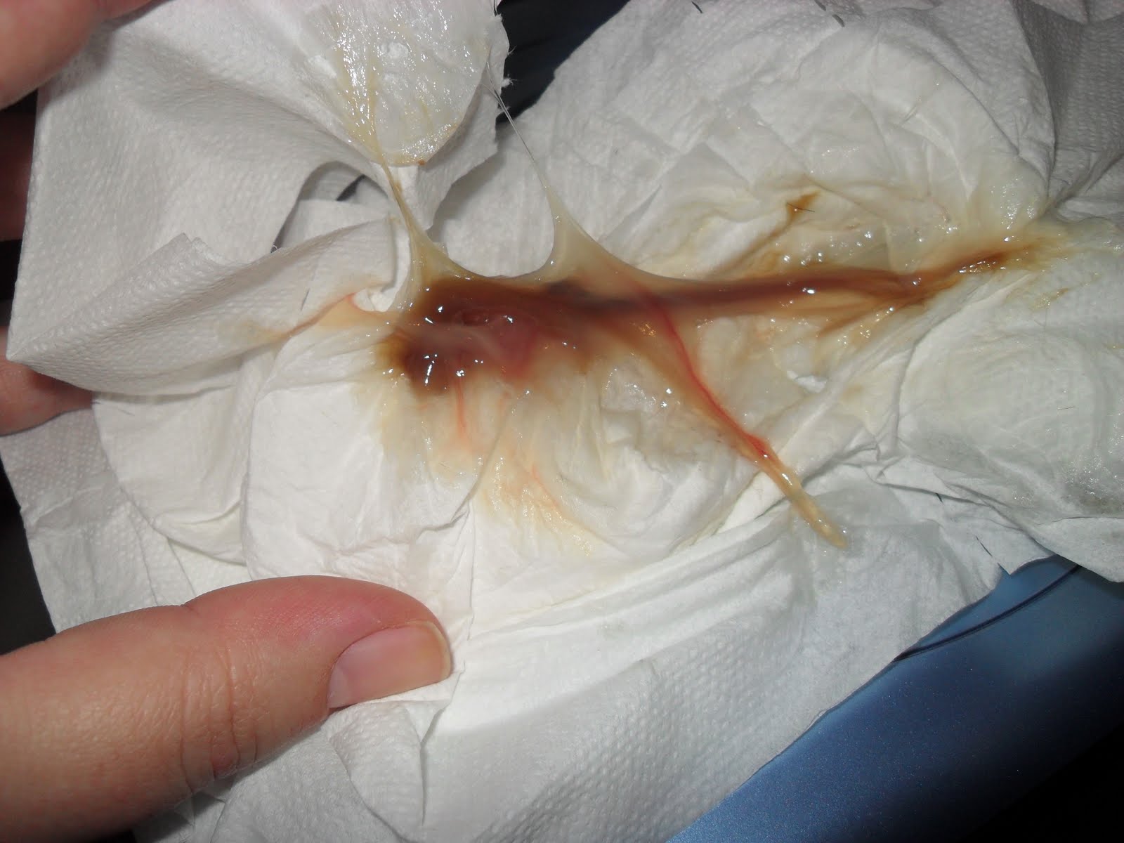 El cuando se tapon mucoso expulsa